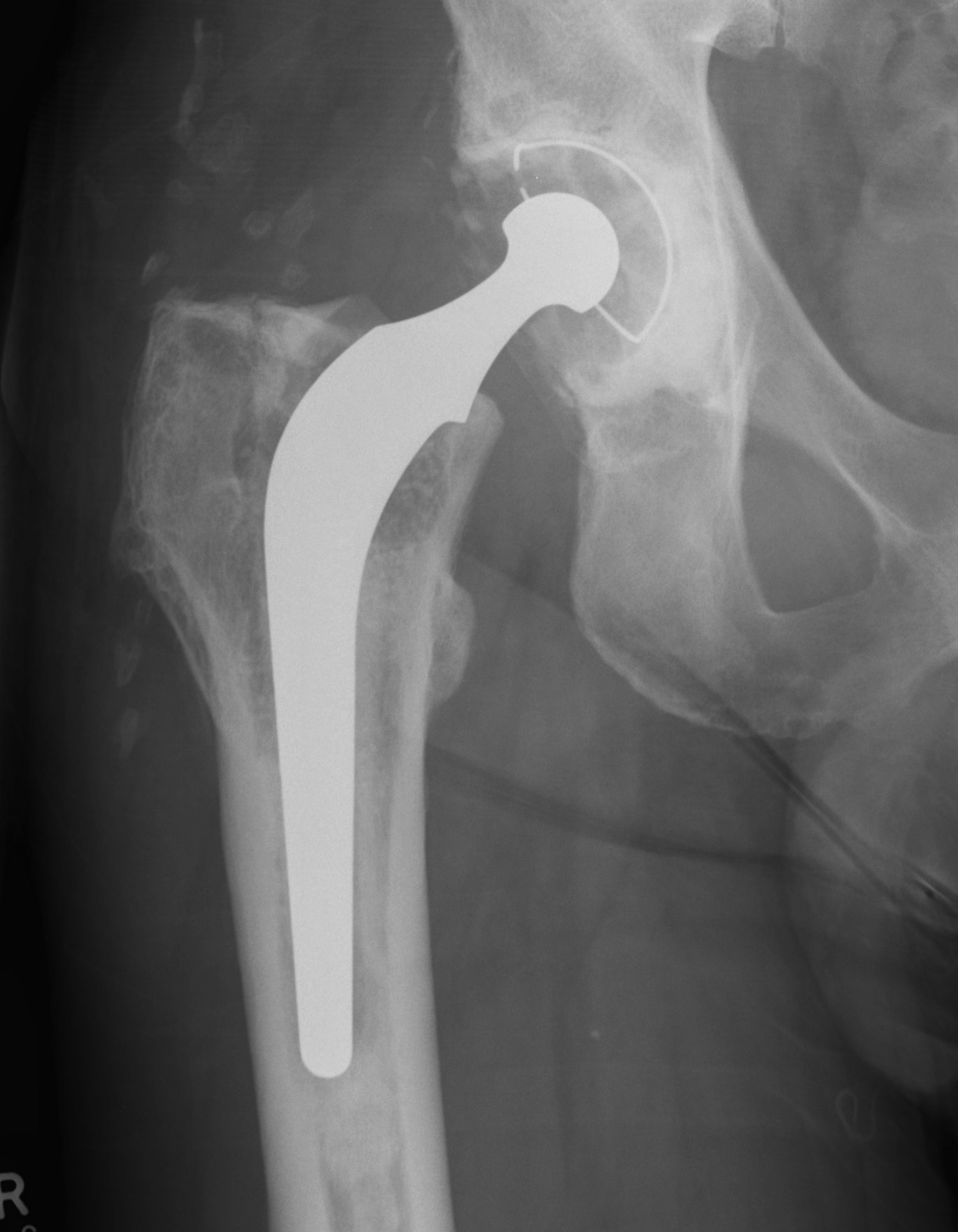 Revision THR Paprosky II Femur